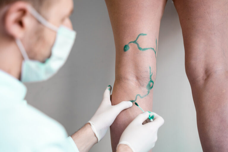 Vein,Markup.,Vascular,Surgeon,Is,Marking,Veins,For,Varicose,Surgery
